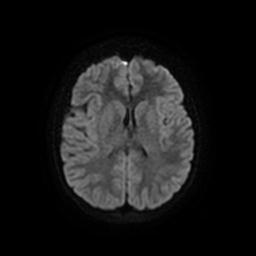 Arachnoid cyst - middle cranial fossa (Radiopaedia 67671-77088 Axial DWI 17).jpg