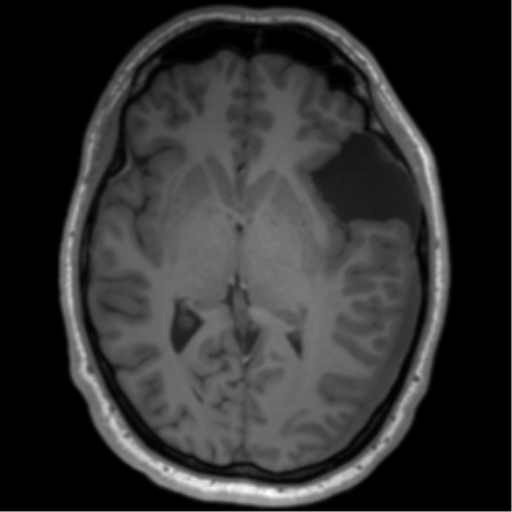 File:Arachnoid cyst with subdural hematoma (Radiopaedia 85892-101743 Axial T1 45).png