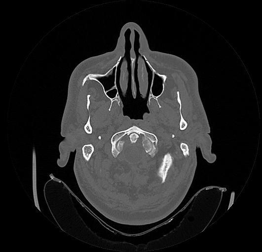 Arcuate foramen (Radiopaedia 89833-106944 Axial bone window 11).jpg