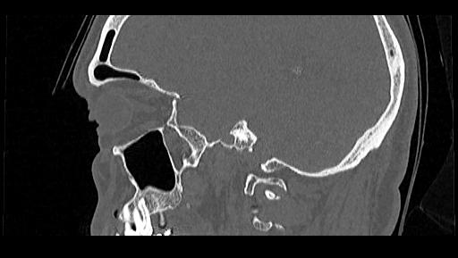 File:Arcuate foramen (Radiopaedia 89833-106944 Sagittal bone window 102).jpg