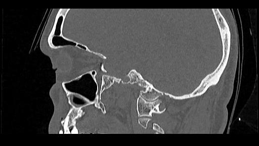 Arcuate foramen (Radiopaedia 89833-106944 Sagittal bone window 94).jpg