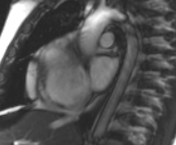 File:Arrhythmogenic right ventricular cardiomyopathy (Radiopaedia 69431-79307 Short axis cine 246).jpg