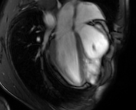 File:Arrhythmogenic right ventricular cardiomyopathy (Radiopaedia 69564-79464 4ch cine 67).jpg