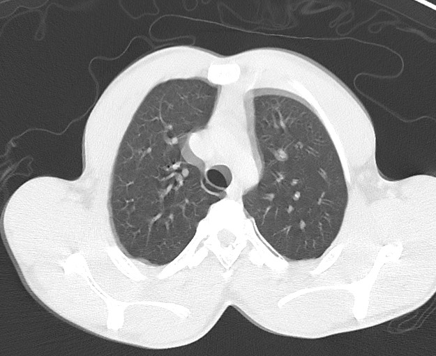 Arrow injury to the chest (Radiopaedia 75223-86321 Axial lung window 13).jpg
