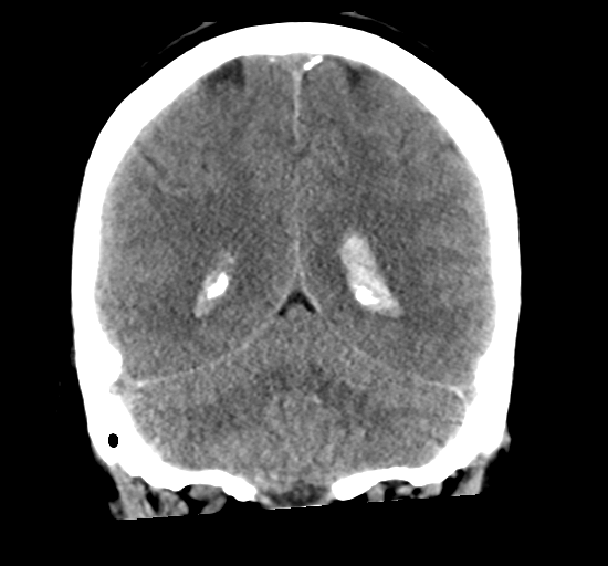 File:Arteriovenous malformation (cerebral) (Radiopaedia 40070-42579 Coronal non-contrast 27).png