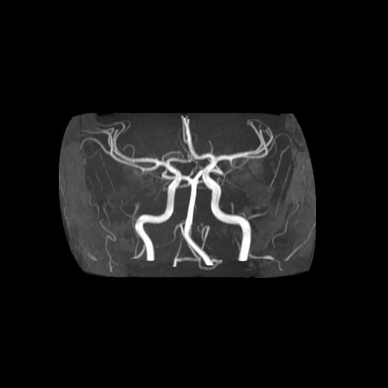 Artery of Percheron infarct (Radiopaedia 40966-43676 F 3).jpg