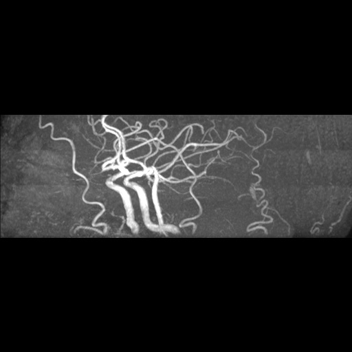Artery of Percheron infarction (Radiopaedia 27975-28230 3D TOF 4).jpg