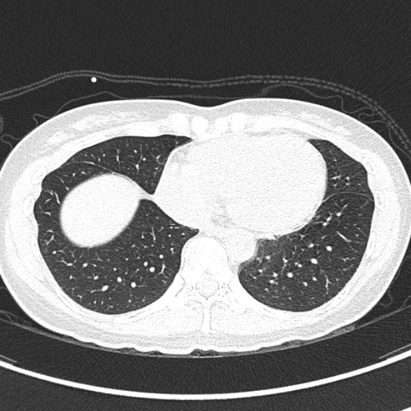 Aspergilloma (Radiopaedia 26223-26347 Axial lung window 56).jpg