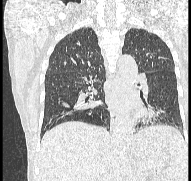Aspergilloma (Radiopaedia 44592-48327 Coronal lung window 80).jpg