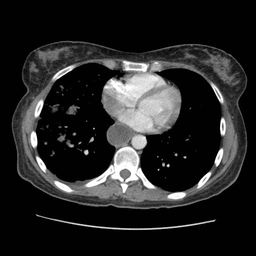 File:Aspiration pneumonia secondary to laparoscopic banding (Radiopaedia 18345-18183 A 34).jpg