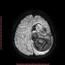 Astroblastoma (Radiopaedia 74287-85162 Axial DWI 83).jpg