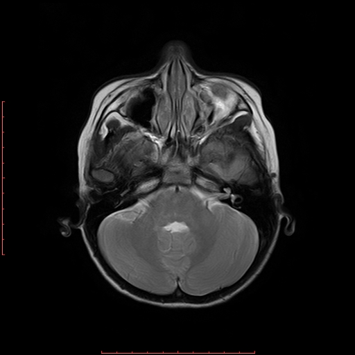 File:Astroblastoma (Radiopaedia 74287-85162 Axial T2 4).jpg