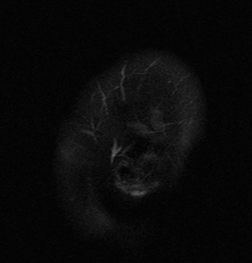 File:Astrocytoma - WHO grade II (Radiopaedia 16279-15959 Sagittal FLAIR 19).jpg