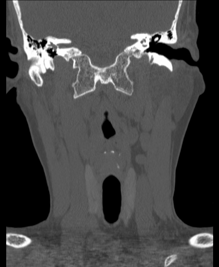 Atlanto-occipital assimilation with basilar invagination (Radiopaedia 70122-80188 Coronal bone window 48).jpg