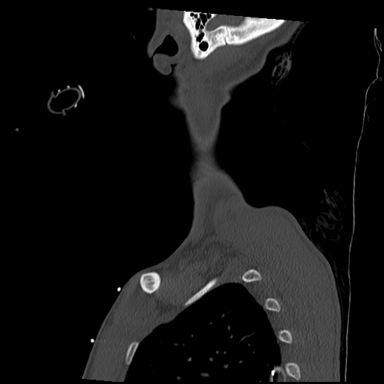 Atlanto-occipital dissociation (Traynelis type 1), C2 teardrop fracture, C6-7 facet joint dislocation (Radiopaedia 87655-104061 Sagittal bone window 67).jpg