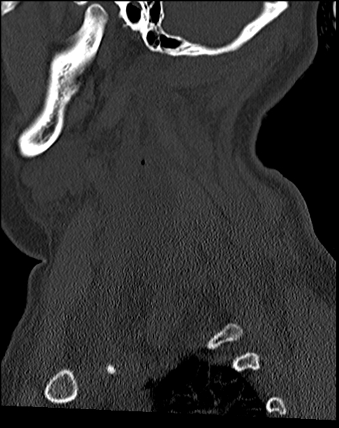 Atlanto-occipital dissociation - Traynelis type 1 (Radiopaedia 87570-103948 Sagittal bone window 65).jpg