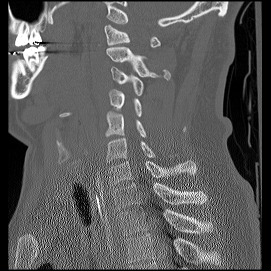 Atlanto-occipital dissociation injury (Radiopaedia 29274-29698 Sagittal bone window 35).png
