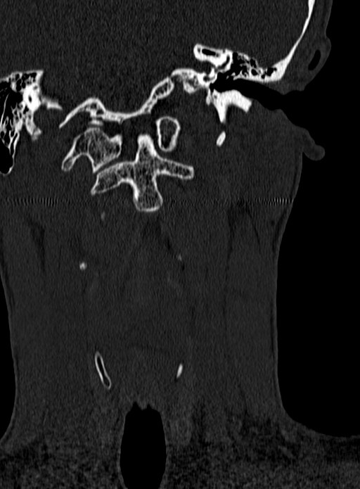Atlantoaxial subluxation (Radiopaedia 44681-48450 Coronal bone window 12).jpg