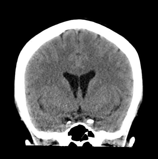 File:Atretic encephalocoele with inferior vermis hypoplasia (Radiopaedia 30443-31107 Coronal non-contrast 17).jpg