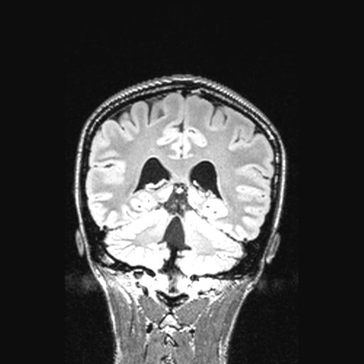 Atretic encephalocoele with inferior vermis hypoplasia (Radiopaedia 30443-31108 Coronal FLAIR 69).jpg