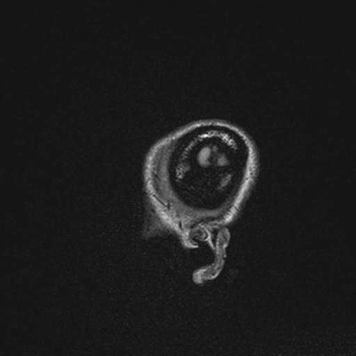 Atretic encephalocoele with inferior vermis hypoplasia (Radiopaedia 30443-31108 Sagittal FLAIR 17).jpg