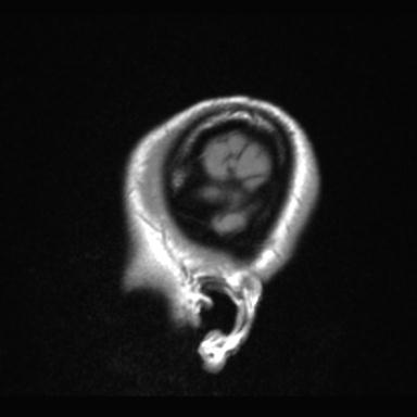 Atretic encephalocoele with inferior vermis hypoplasia (Radiopaedia 30443-31108 Sagittal T1 2).jpg