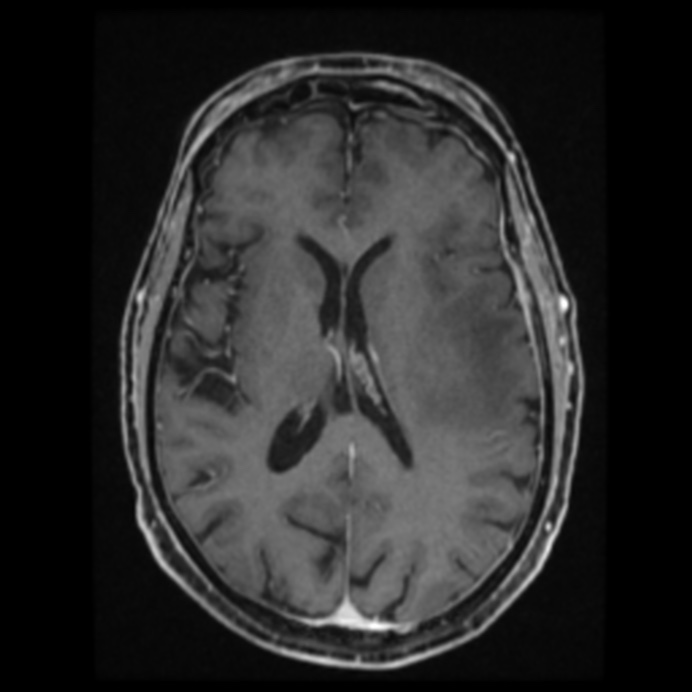 Atypical meningioma (Radiopaedia 45535-49629 Axial T1 C+ 41).jpg