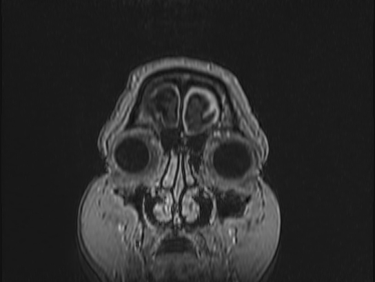 Atypical meningioma (Radiopaedia 62985-71406 Coronal T1 C+ 3).jpg