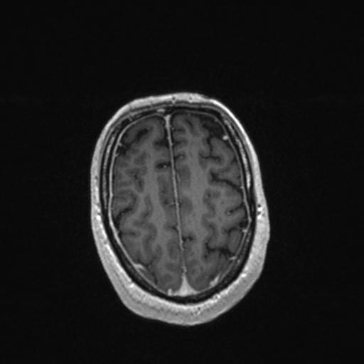 Atypical meningioma (grade II) - en plaque (Radiopaedia 29633-30147 Axial T1 C+ 149).jpg