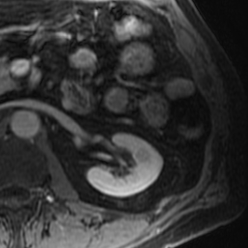 File:Atypical renal cyst on MRI (Radiopaedia 17349-17046 D 17).jpg