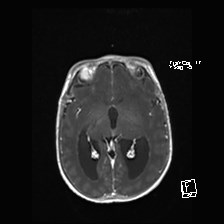 Atypical teratoid rhabdoid tumor (prenatal US and neonatal MRI) (Radiopaedia 59091-66388 Axial T1 C+ 30).jpg