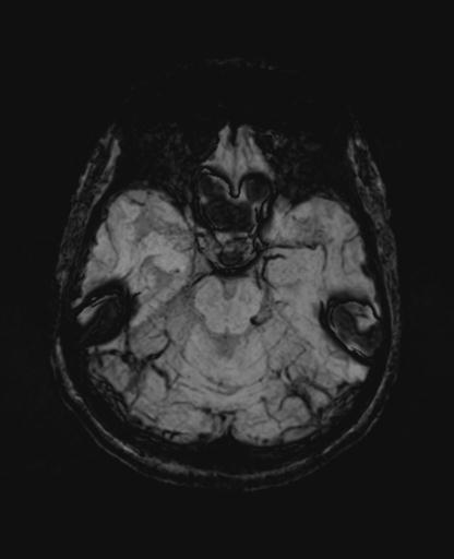 File:Autoimmune limbic encephalitis (Radiopaedia 30363-31005 SWI - mIP 24).jpg