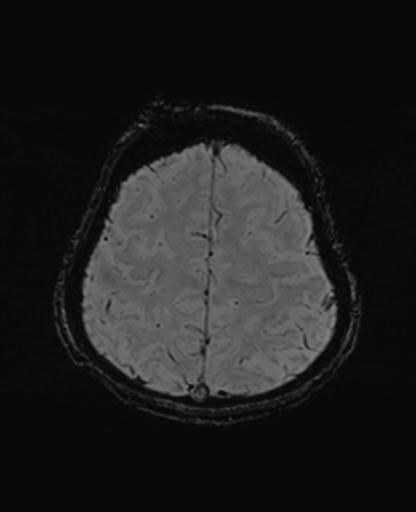 Autoimmune limbic encephalitis (Radiopaedia 30363-31005 SWI 65).jpg