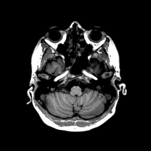 Autoimmune limbic encephalitis (Radiopaedia 30363-31005 T1 Axial 1mm 35).jpg