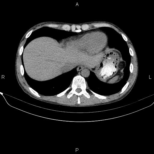 Autoimmune pancreatitis (Radiopaedia 84925-100431 Axial non-contrast 7).jpg