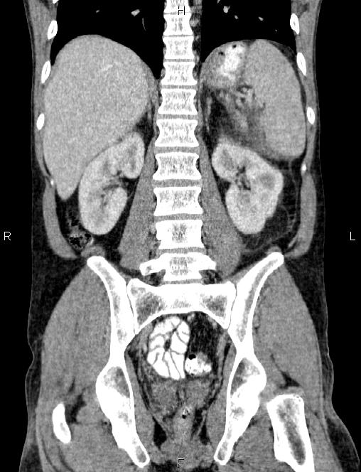 Autoimmune pancreatitis (Radiopaedia 84925-100431 D 41).jpg