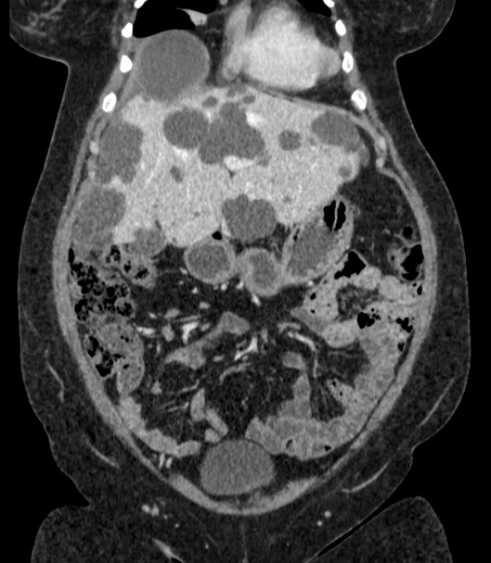 Autosomal dominant polycystic kidney disease (Radiopaedia 57124-64017 B 22).jpg