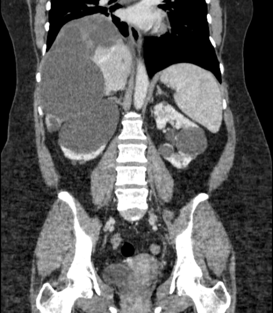 Autosomal dominant polycystic kidney disease (Radiopaedia 57124-64017 B 48).jpg