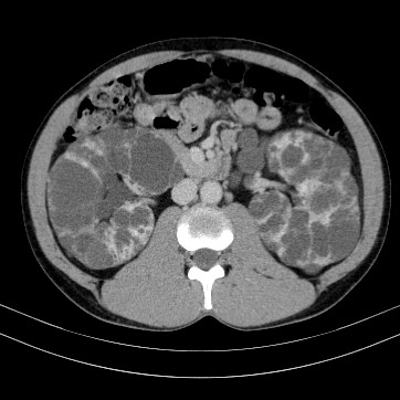 Autosomal dominant polycystic kidney disease (Radiopaedia 66349-75582 B 42).jpg