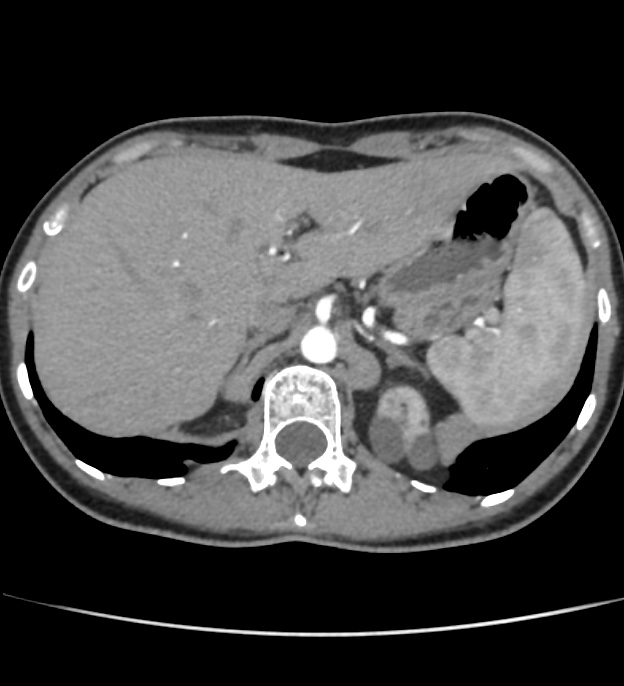 Autosomal dominant polycystic kidney disease - early onset (Radiopaedia 40734-43387 B 1).jpg