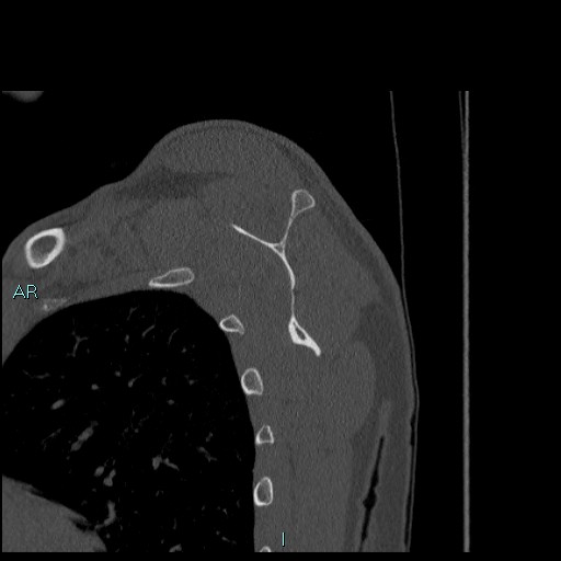 Avascular necrosis after fracture dislocations of the proximal humerus (Radiopaedia 88078-104655 Sagittal bone window 51).jpg