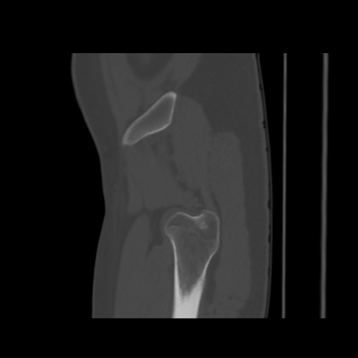 Avascular necrosis of the hip (Radiopaedia 61503-69467 B 6).jpg