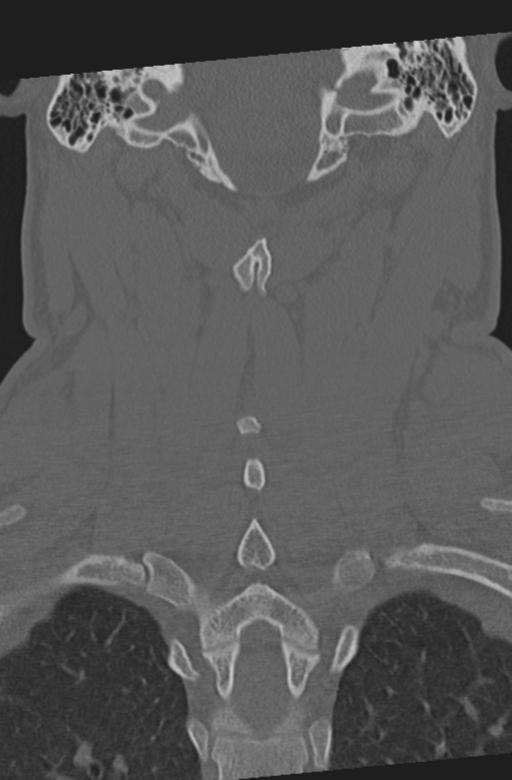 Axis peg fracture (type 3) and atlas lateral mass (type 4) fracture (Radiopaedia 37474-39324 Coronal bone window 41).png