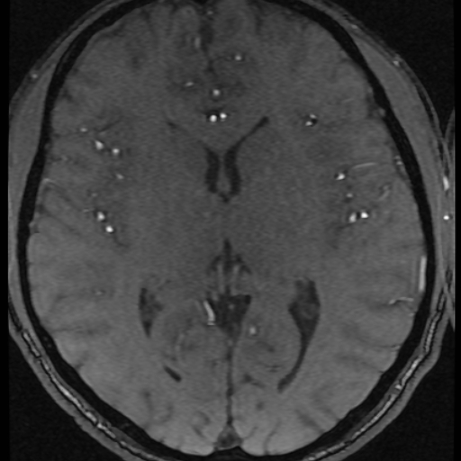 Azygos anterior cerebral artery (Radiopaedia 17059-16756 Axial MRA 10).jpg