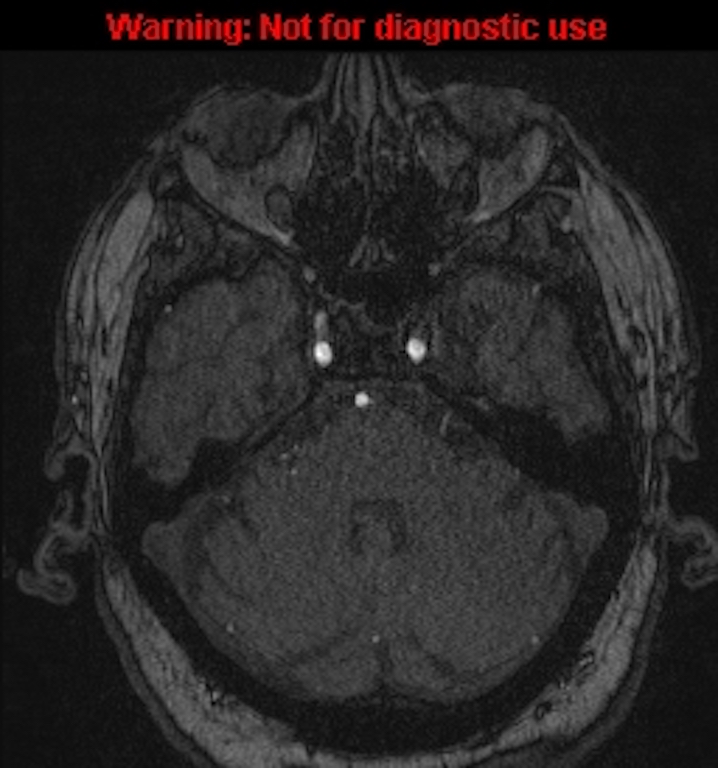 Azygos anterior cerebral artery (Radiopaedia 59325-66677 Axial MRA 41).jpg