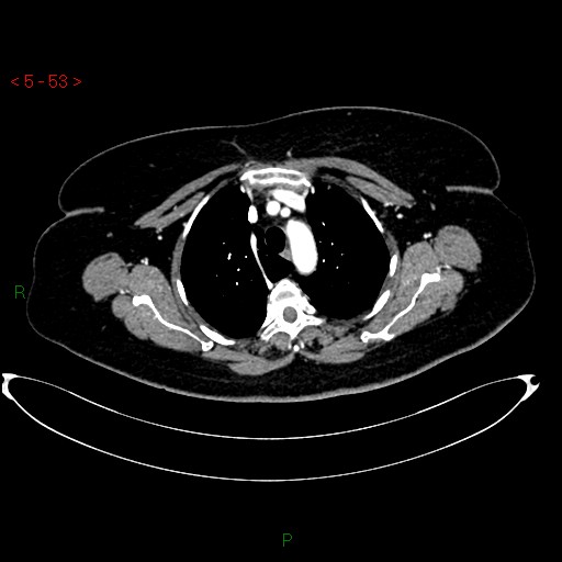 File:Azygos fissure and lobe (Radiopaedia 47620-52278 A 39).jpg
