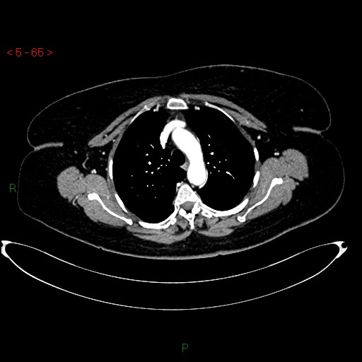 Azygos fissure and lobe (Radiopaedia 47620-52278 A 51).jpg