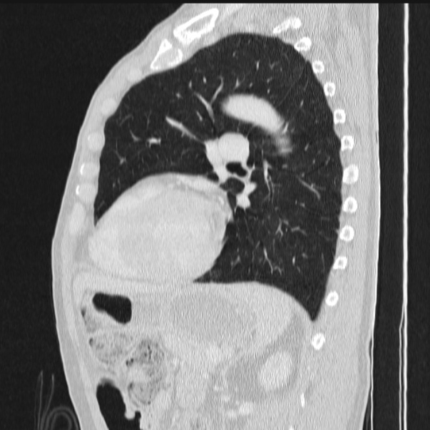 Azygos lobe (Radiopaedia 38259-40275 lung window 63).jpg