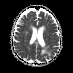 File:Balo concentric sclerosis (Radiopaedia 53875-59982 Axial ADC 16).jpg