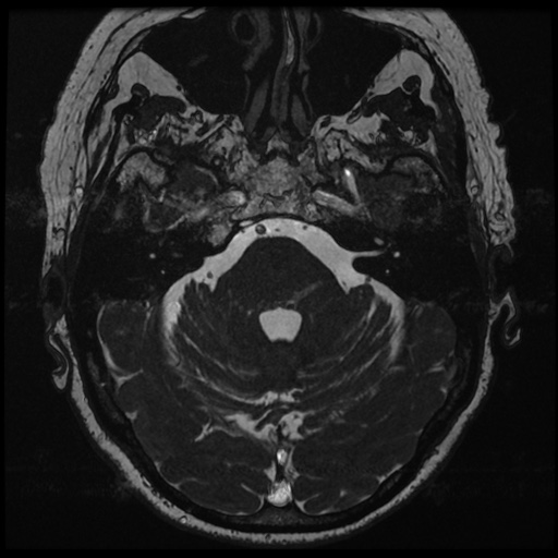 File:Balo concentric sclerosis (Radiopaedia 53875-59982 Axial T2 FIESTA 44).jpg
